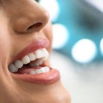 Why Veneers Are the Go-To Smile Fix for Sugar Land Residents