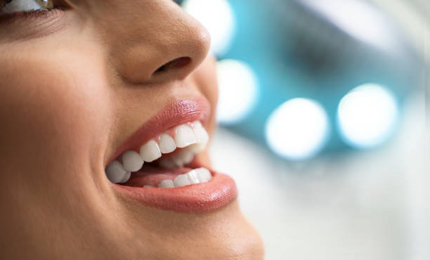 Why Veneers Are the Go-To Smile Fix for Sugar Land Residents