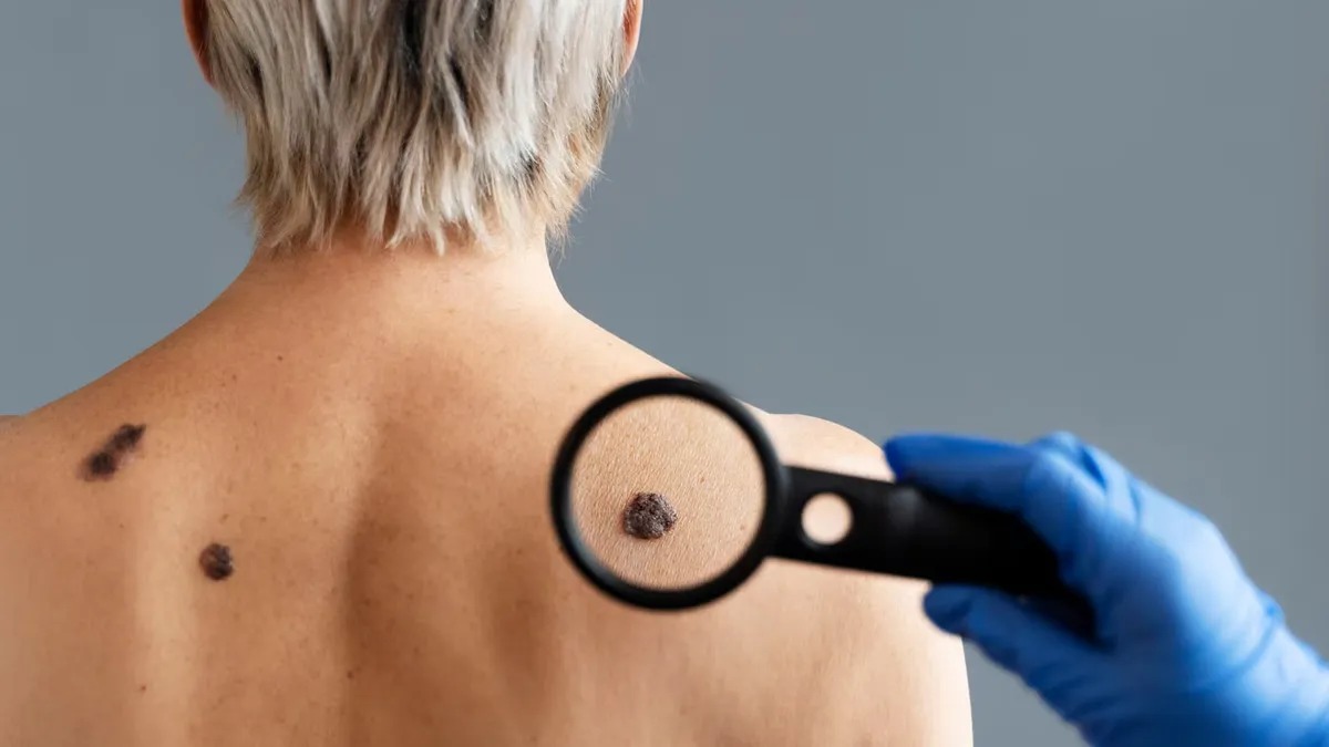 Why Melanoma Affects Women and Men Differently Before and After Age 50